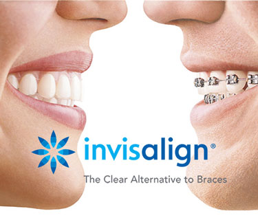 Invisalign Brasil - O tratamento Invisalign permite que sua higiene bucal  seja simples e eficaz. Seu dia a dia não muda. www.invisalign.com.br